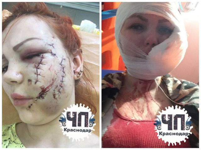 В Апшеронске пьяные женщины изуродовали девушке лицо, уже месяц не возбуждается уголовное дело