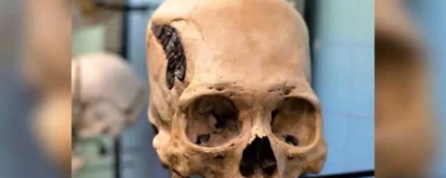 Череп древнего воина с металлической пластиной (Фото)