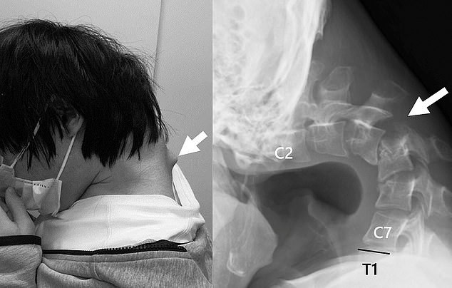 25-летний японец утратил способность поднимать голову