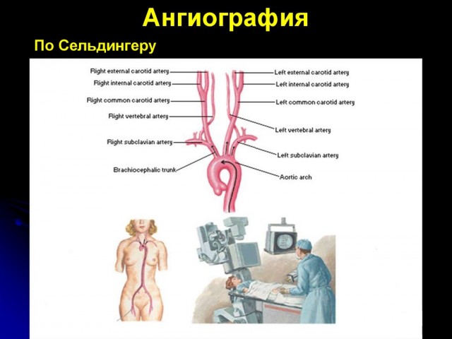 Инсульт у мамы в москве