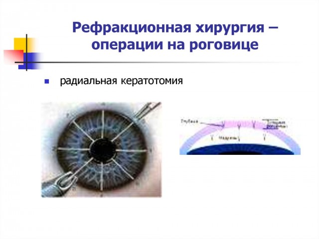 Лазерная хирургия глаза