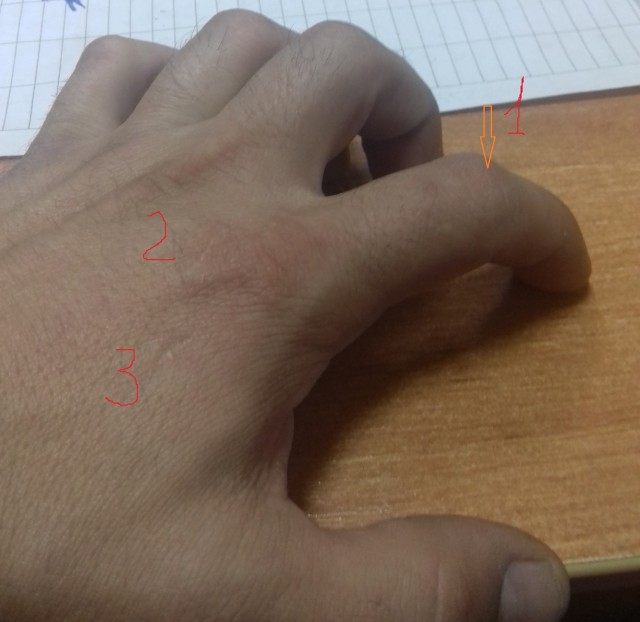 Шрамы на пальце - есть у всех? У меня даже два!