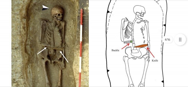 Протезирование у варваров или мужик с рукой-ножом