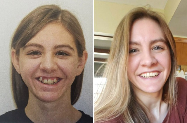 Спустя 9 лет ношения брекетов