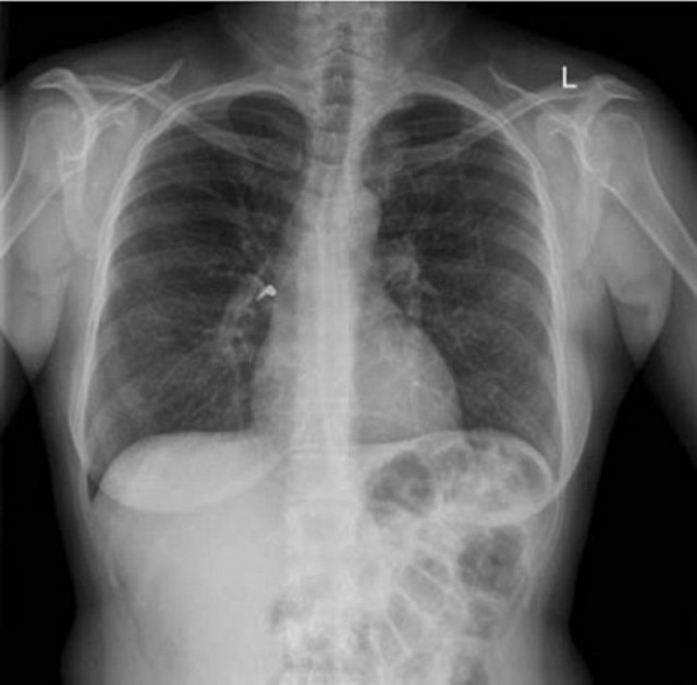 Самые неожиданные вещи, найденные в теле человека