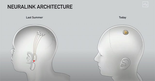 Илон Маск показал обновлённый нейроинтерфейс Neuralink — беспроводной чип Link в форме монеты