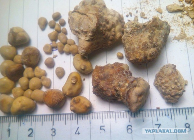 Врачи московской больницы имени С.И. Спасокукоцкого спасли почку мужчины, удалив из нее 7 сантиметровый камень