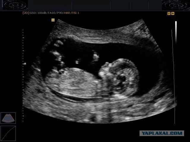 Радость материнства и аборт