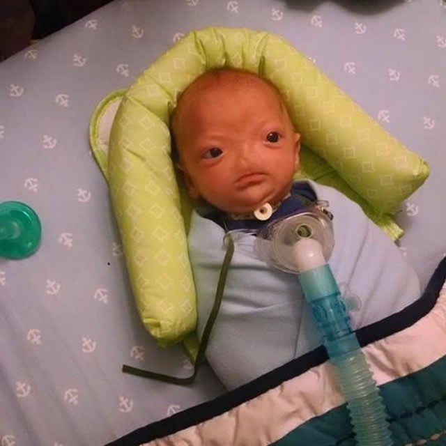 В Алабаме родился малыш без носа