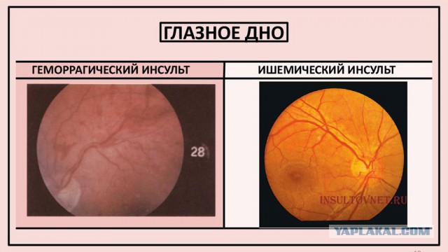 Что ищут офтальмологи на глазном дне?