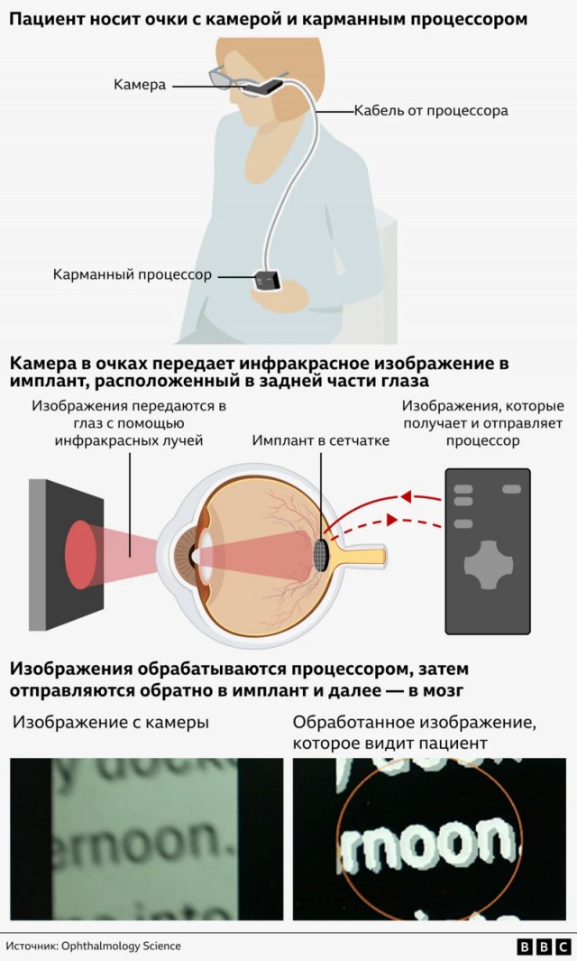 Ученые разработали имплант, с помощью которого ослепшие пациенты снова могут читать