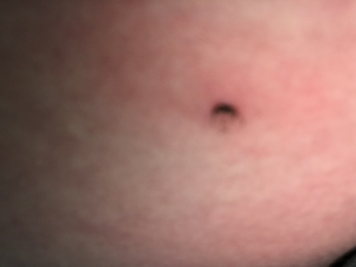 Как меня укусил клещ, первый раз. И заразный, сука