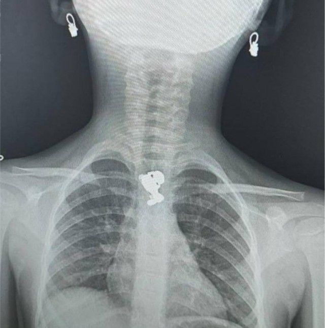 Маленькая девочка съела мамину брошь