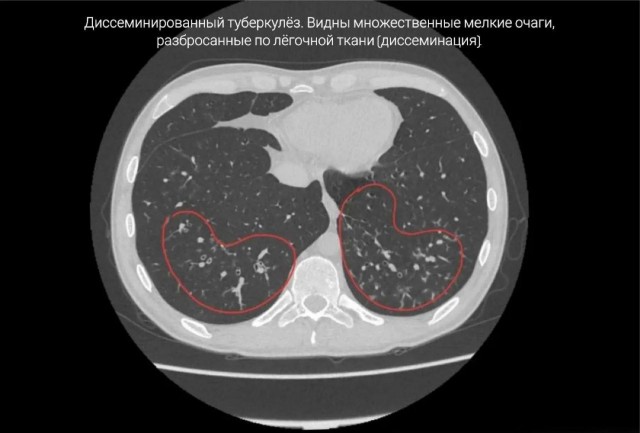 Куривший вейпы 17 лет приморец попал в больницу, его не спасли