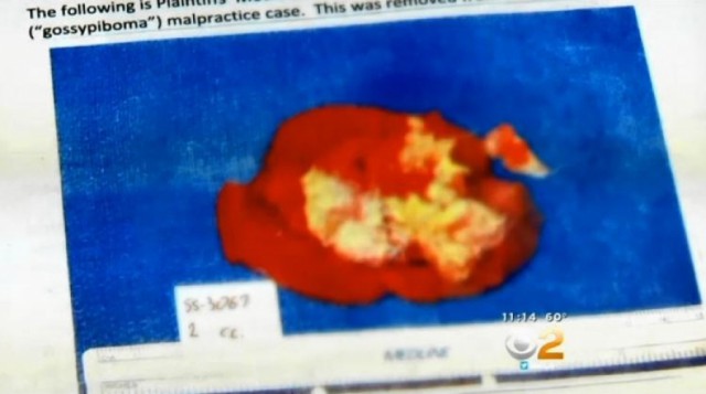 Самые неожиданные вещи, найденные в теле человека