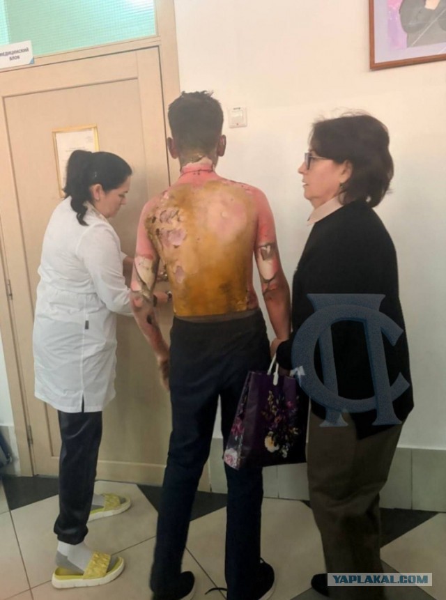 В Красноярске восьмиклассница облила бензином и подожгла одноклассника