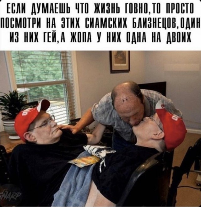 Паразитический краниопаг