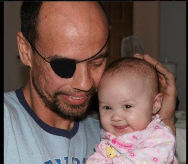 Потерял пол-лица и стал профессиональным зомби