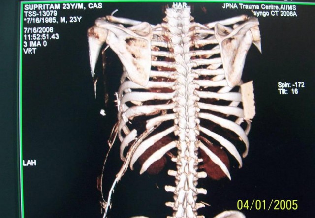 Португальский парень чудом выжил, после того как его проткнуло железякой