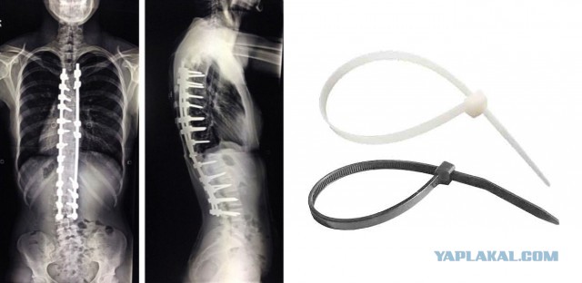 Сильная девушка до, во время и после операции на позвоночнике