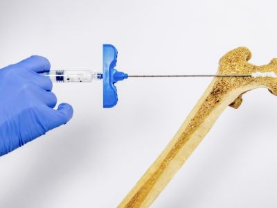 Новый гидрогель восстанавливает структуру костей всего за две недели