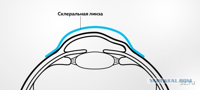 Что ищут офтальмологи у пациентов с астигматизмом?