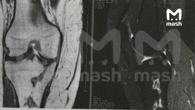 Ампутация ног грозит жительнице Краснодара после безобидной липосакции ягодиц. Итог процедуры: некроз тканей, нарушение кровотока и перспектива смерти.