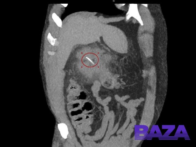 Рыбак из Подмосковья едва не погиб, поужинав жареной рыбой