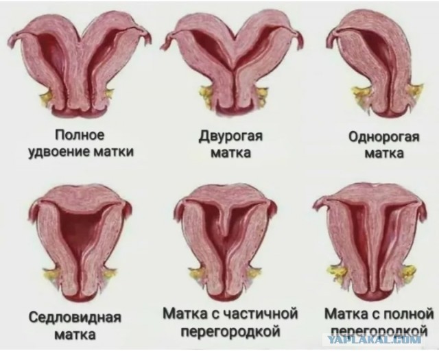 Британка, родившаяся с двумя вагинами, призналась, что у неё есть два бойфренда. Девушка утверждает, что она не изменяет им