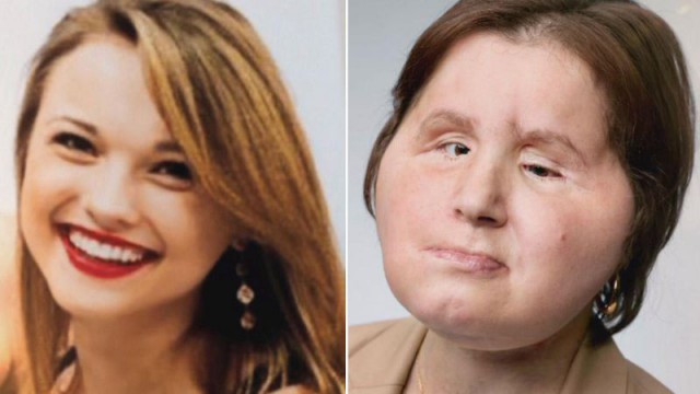 В свои 21 она является самой молодой женщиной, которой сделали пересадку лица.