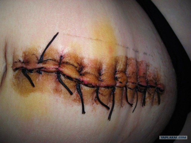 Начало новой жизни:Кесарево сечение своими глазами