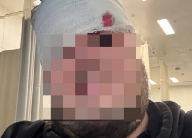 Кусок лепнины едва не убил пассажира в московском метро — мужчина получил тяжёлую травму головы.
