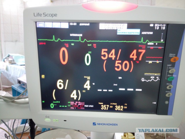Искусственное кровообращение