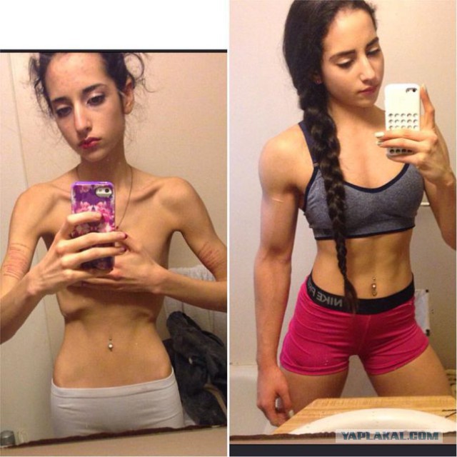 Девушка-анорексичка взялась за себя и выздоровела