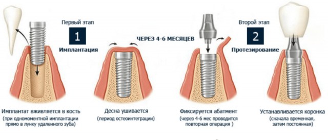 Про вкладки, коронки и импланты