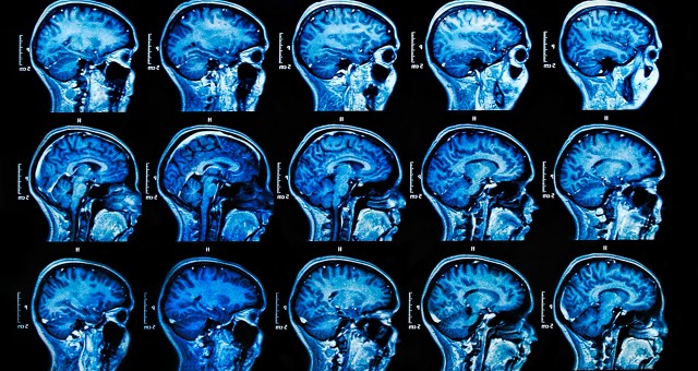 Исследование: переработки буквально меняют мозг