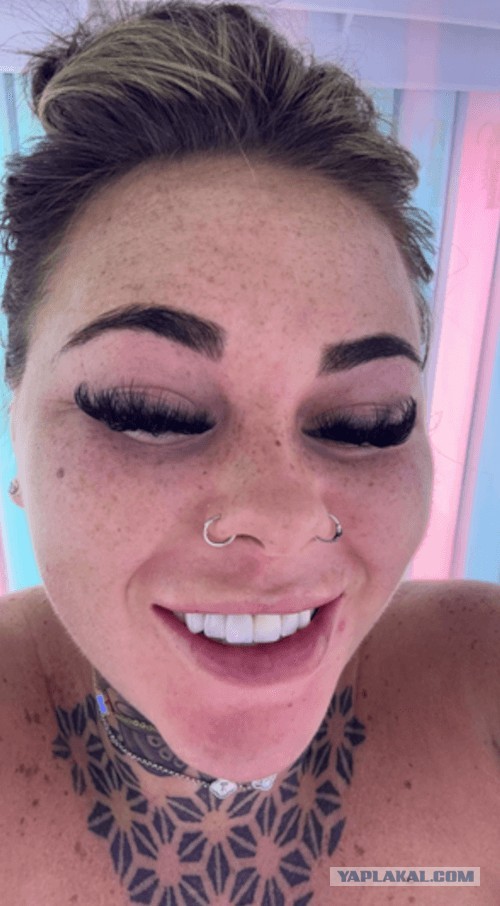 Решив получше загореть, девушка получила сильный ожог лица