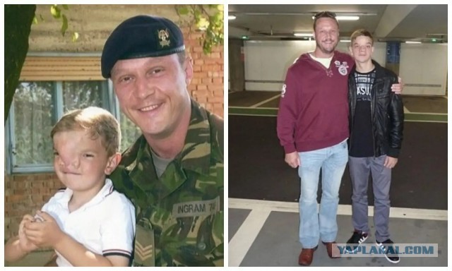 Британский солдат собрал деньги на операцию для мальчика из Боснии, который родился с редким дефектом на лице