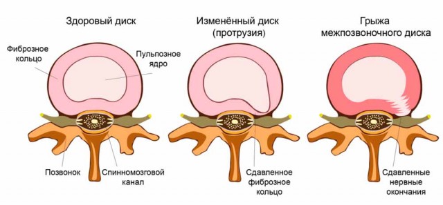 Руководство Wildberries отказалось выплачивать компенсацию сотруднику, который чуть не остался инвалидом