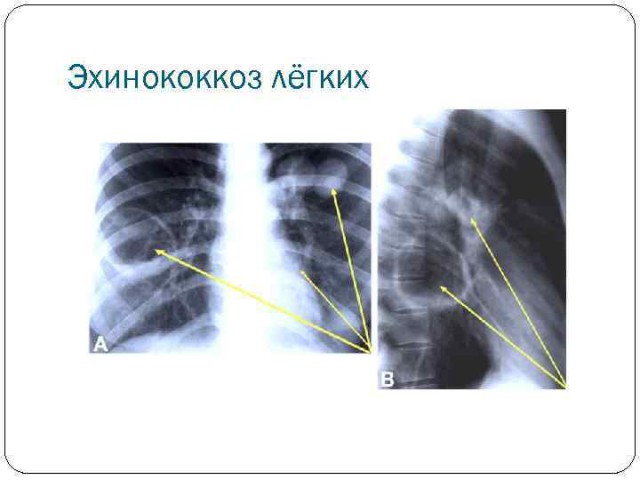 В легких суворовцев нашли личинок червей