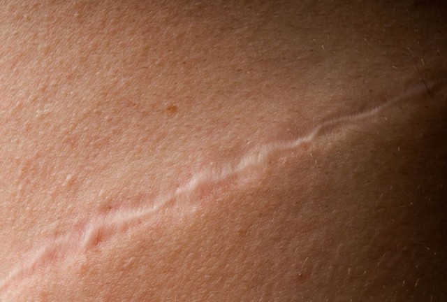 Ученые создали крем, который убирает шрамы