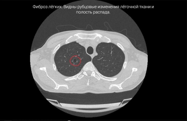 Куривший вейпы 17 лет приморец попал в больницу, его не спасли