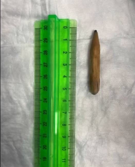 В Москве 11-летний мальчик случайно проглотил карандаш