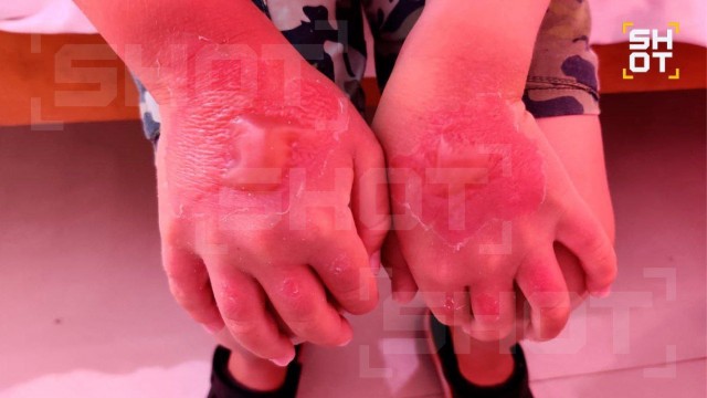 Мальдивы превращаются в «гриль»: туристы из России массово обгорают.