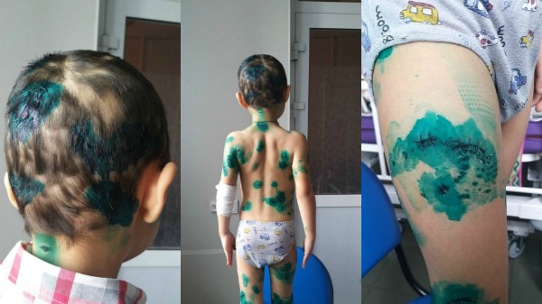 Родственница пострадавшего от собак мальчика в Улан-Удэ: «Смотрим мультики про добрых собачек»