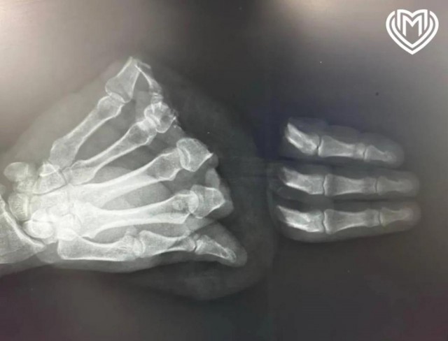 Московские хирурги пришили мужчине отрезанные пальцы, случайно отрезанные бензопилой