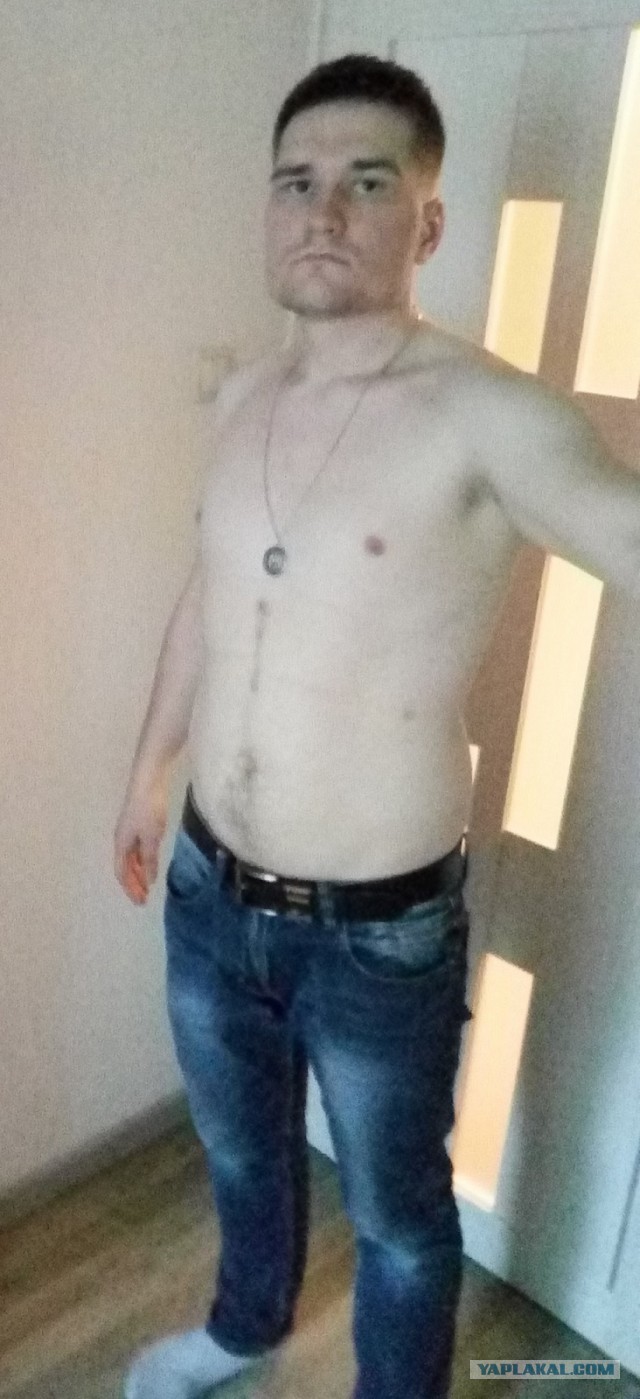 Гастрошунтирование или как я стал стройным