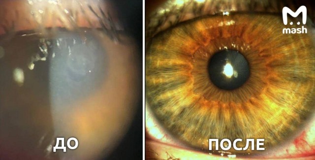 Подросток из Москвы не снимал однодневные линзы три месяца и чуть не ослеп