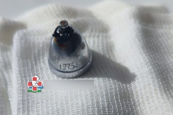 Железный колокольчик достали из легких мужчины в Екатеринбурге