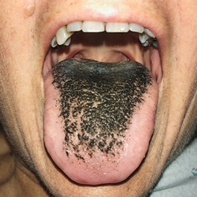 Черный волосатый язык